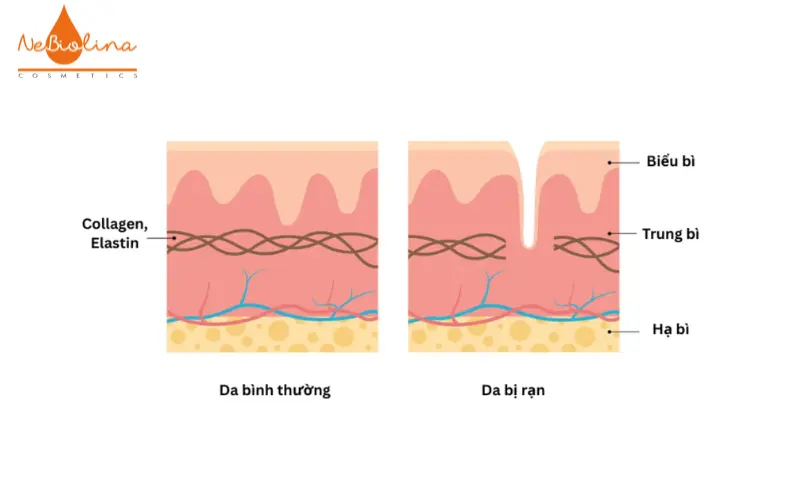 Đứt gãy collagen, elastin tạo nên những vết rạn da