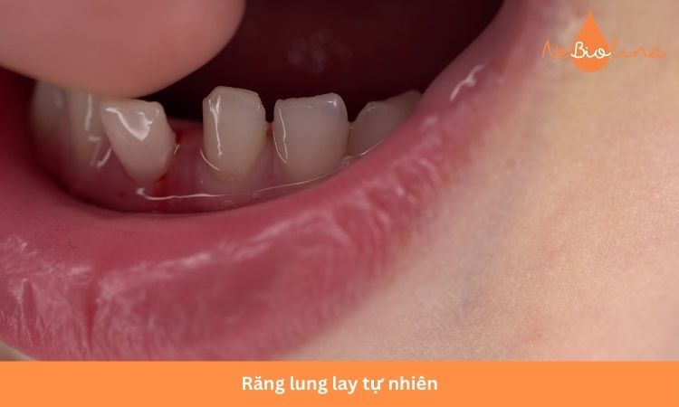 Bé 5 tuổi thay răng sữa tự nhiên.