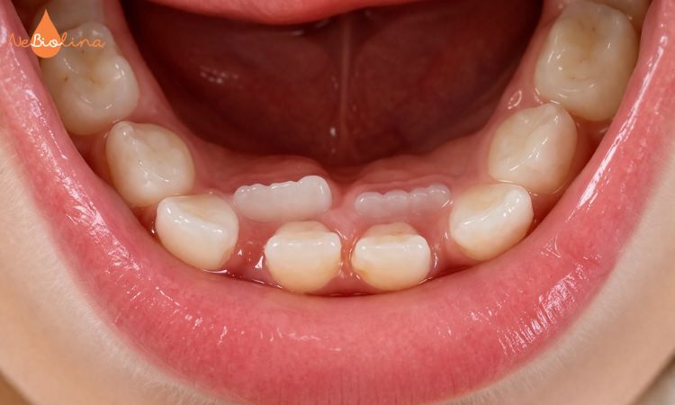 Răng vĩnh viễn mọc chồi.