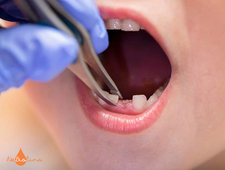 Khi răng sữa bị vỡ chỉ còn chân răng thì cần đưa trẻ tới nha sĩ nhổ răng