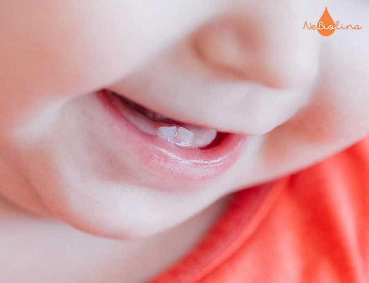 Răng sữa mọc lệch là tình trạng khá phổ biến ở trẻ