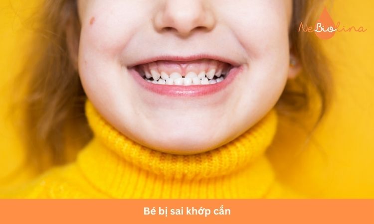 Bé bị sai khớp cắn ảnh hưởng đến thẩm mỹ.