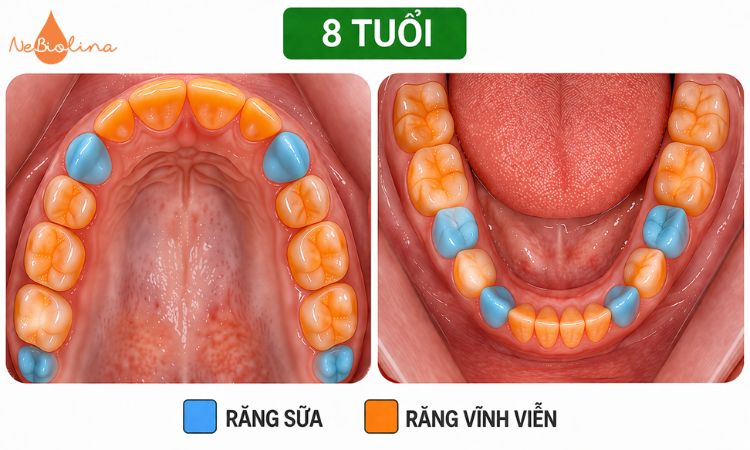 Răng sữa và răng vĩnh viễn cùng tồn tại khi bé 8 tuổi.