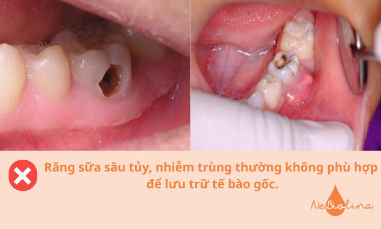 Răng sữa sâu tủy, nhiễm trùng thường không phù hợp để lưu trữ tế bào gốc.
