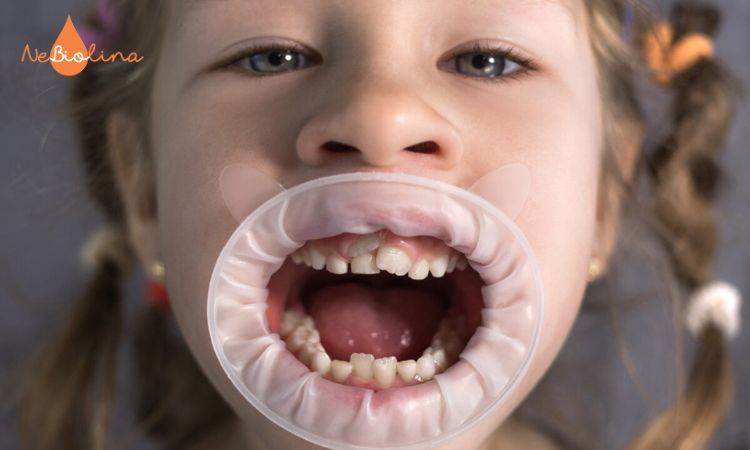 Răng mọc lẫy có thể dẫn đến răng vĩnh viễn mọc lệch hoặc chen chúc