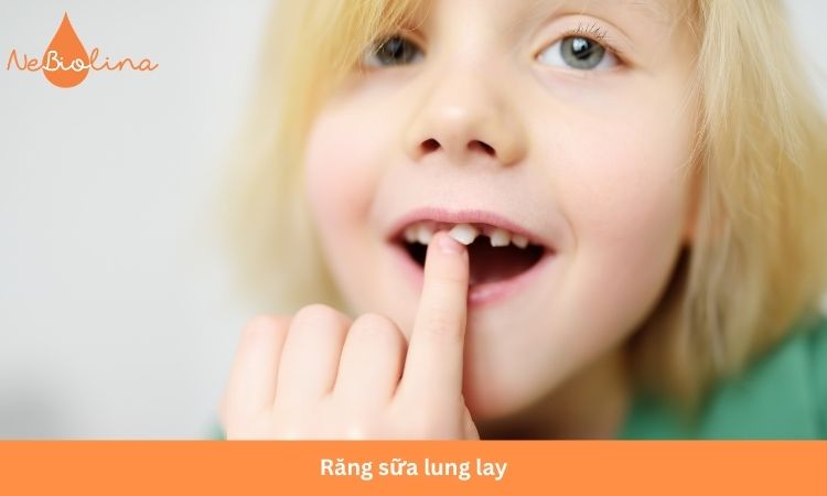 Răng sữa lung lay cấp độ 3 hoặc 4 là phù hợp để nhổ răng. 