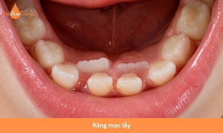 Răng mọc lẫy dễ gây lệch khớp cắn.