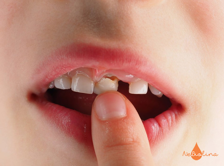 Bố mẹ cần kiểm tra xem chiếc răng đã thực sự lung lay để nhổ chưa