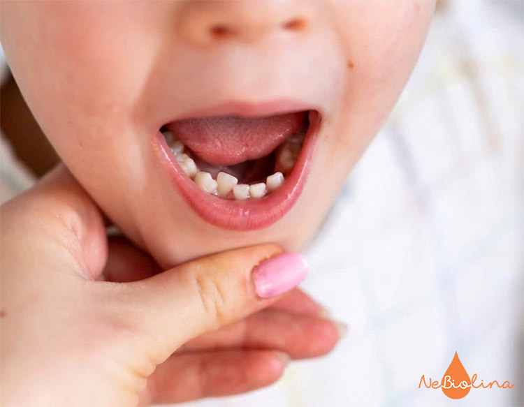 Răng sữa mọc lệch có thể làm thay đổi hướng mọc của răng vĩnh viễn