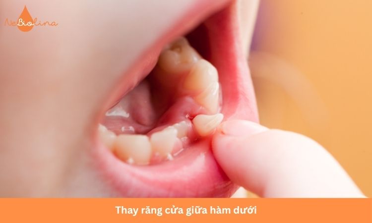 Răng cửa giữa hàm dưới thường được thay đầu tiên.