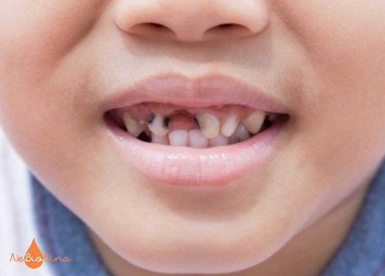 Bố mẹ cần theo dõi tình trạng sâu răng của bé để xử lý kịp thời