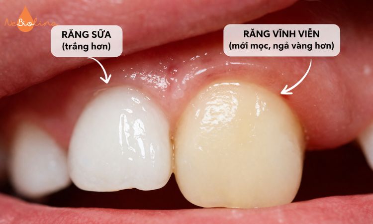 Hình ảnh răng sữa và răng vĩnh viễn với màu sắc khác nhau.