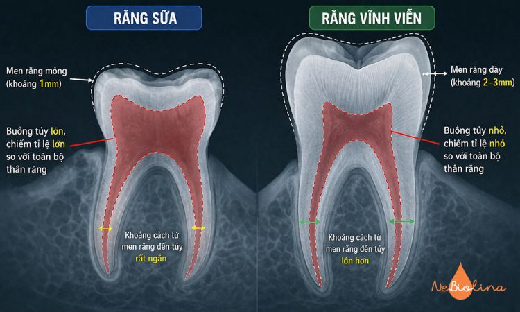 Buồng tuỷ răng sữa dễ lộ, trong khi đó răng vĩnh viễn ít nguy cơ hơn.