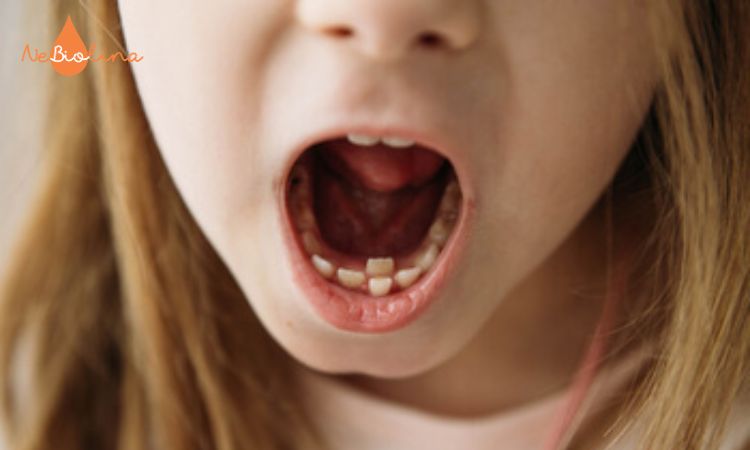  Răng mọc lẫy ở trẻ