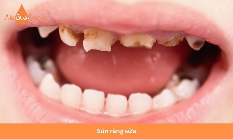 Răng sún ngả màu vàng nâu.