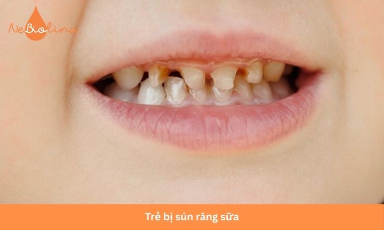 Trẻ bị sún răng sữa do thói quen bú đêm.