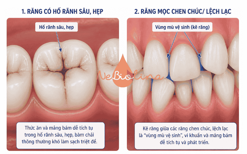 Răng chen chúc, hỗ rãnh sâu tăng nguy cơ sâu răng