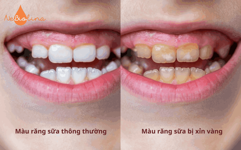 Răng sữa thông thường và răng sữa bị xỉn