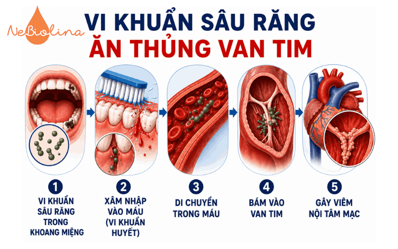 Vi khuẩn sâu răng ăn thủng van tim