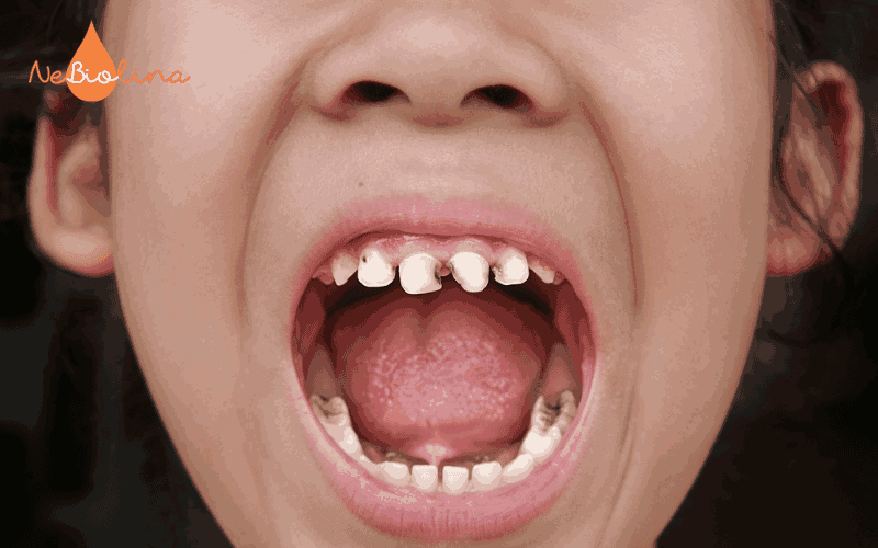 Trẻ bị sâu răng 