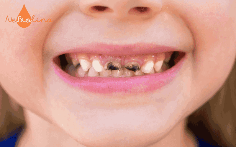 Trẻ nhỏ bị sâu răng cửa