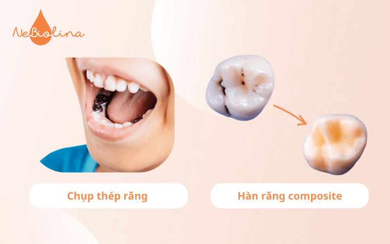 So sánh chụp thép răng sữa với hàn răng 