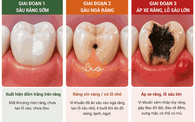 Dấu hiệu của sâu răng 