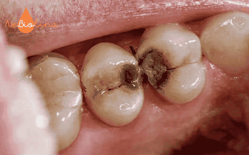 Sâu kẽ răng không phải do lây vi khuẩn sâu răng
