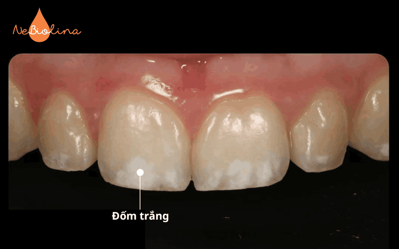 Răng xuất hiện đốm trắng