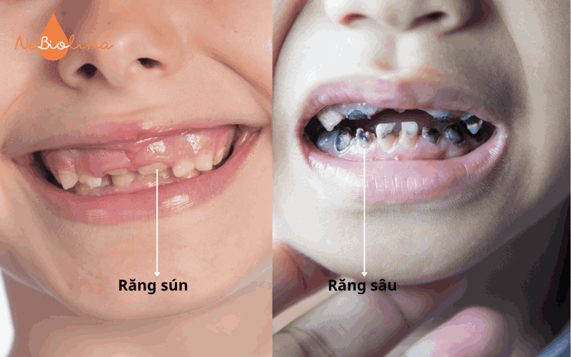 Phân biệt răng sún và răng sâu