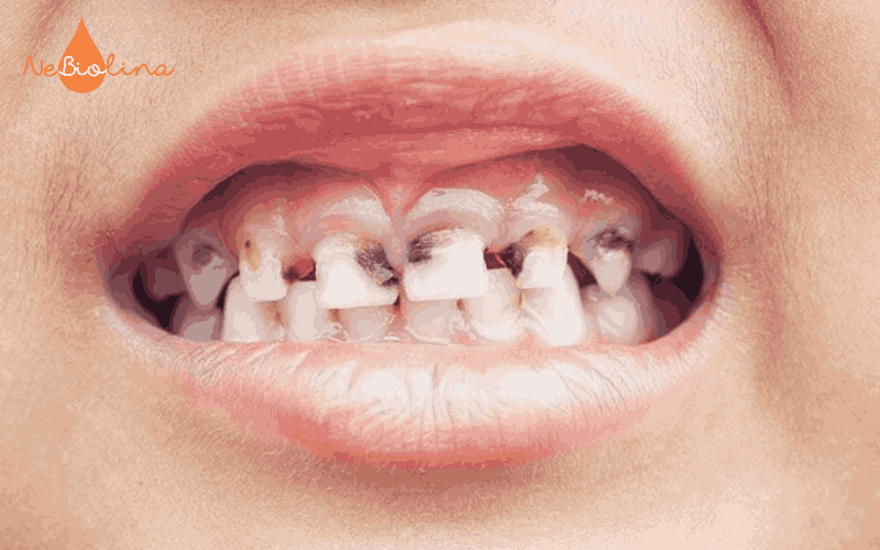 Răng của trẻ bị xỉn màu đen