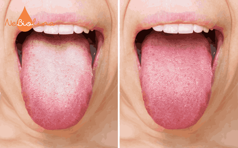 Lưỡi trước và sau khi được vệ sinh