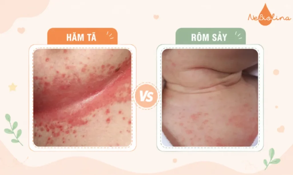 Phân biệt hăm tã và rôm sẩy