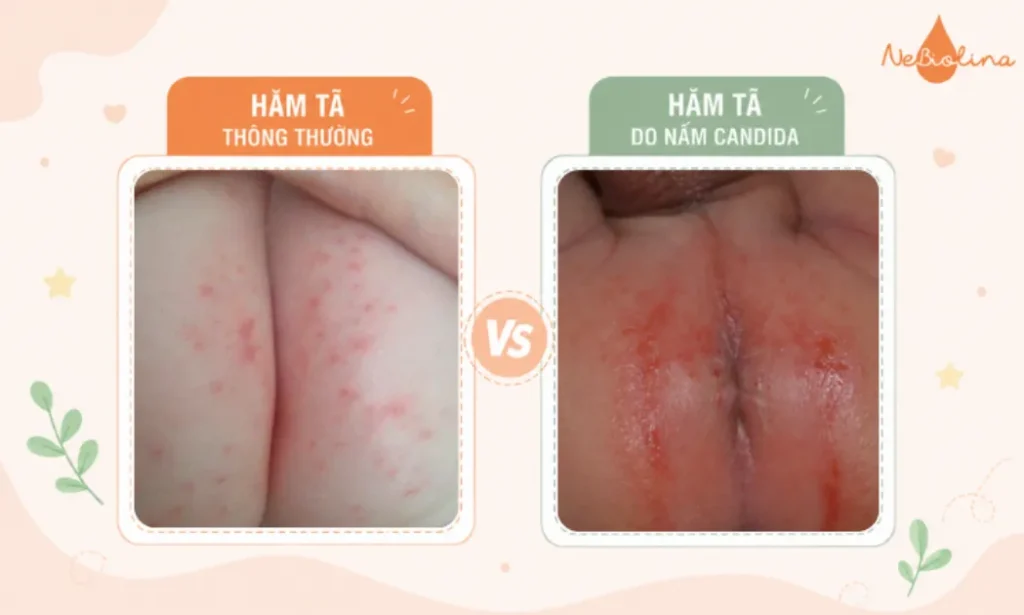 Phân biệt hăm tã thông thường và hăm tã do nấm Candida