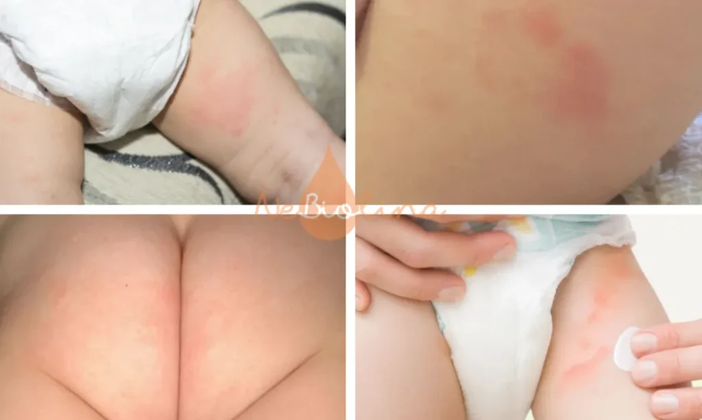 Hình ảnh hăm tã cấp độ 1 ở trẻ sơ sinh