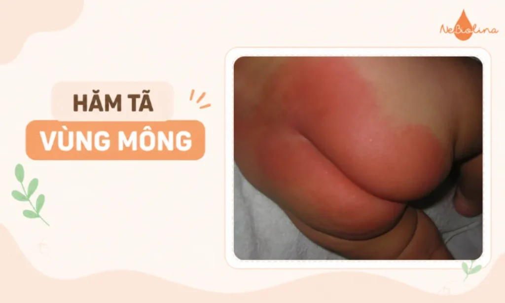 Hình ảnh hăm tã ở vùng mông