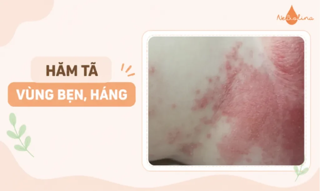 Hình ảnh hăm tã ở bẹn, háng
