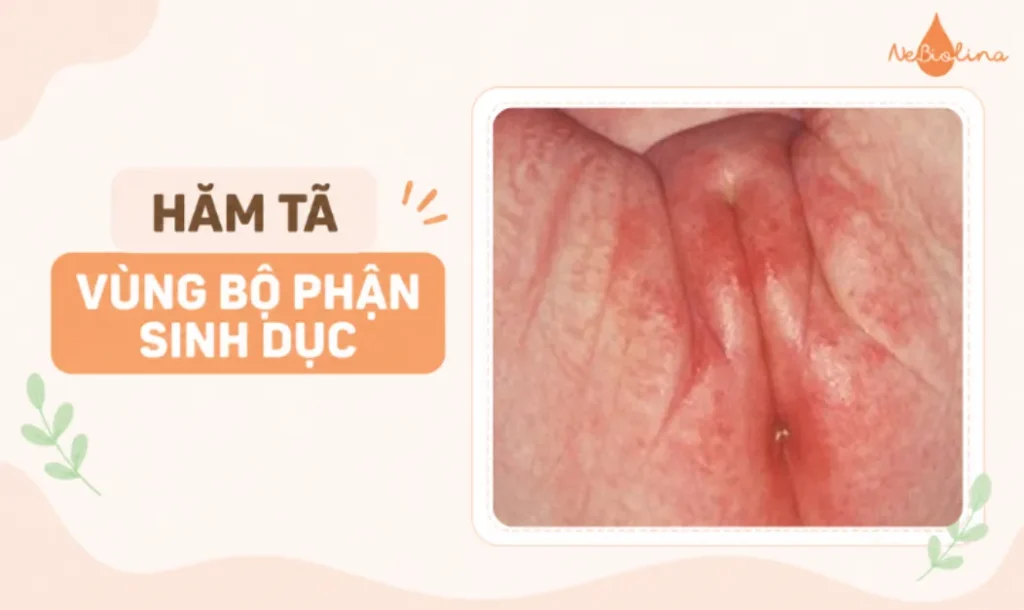 Hình ảnh hăm tã ở bộ phận sinh dục