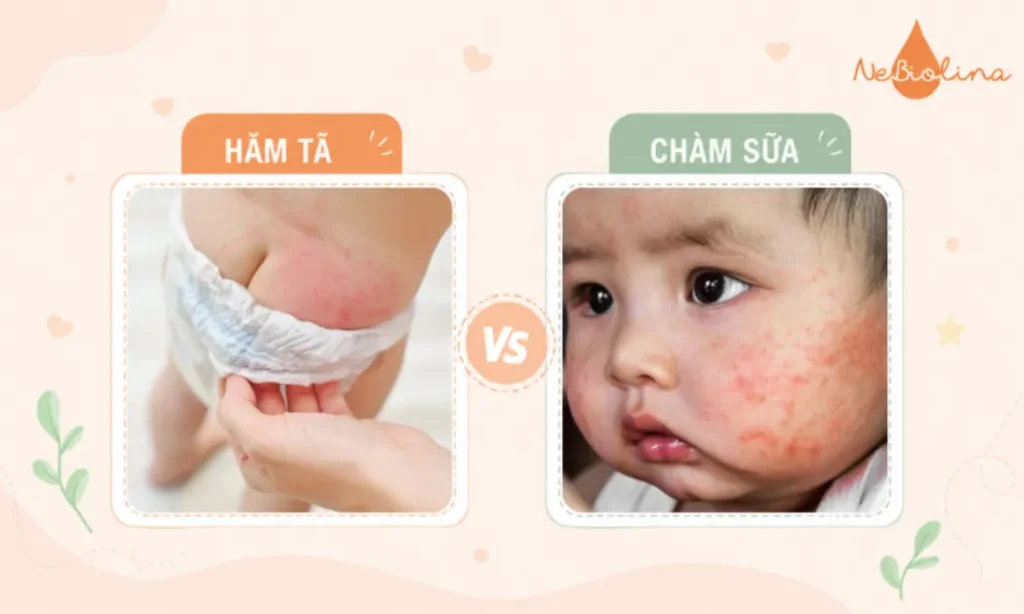 Phân biệt hăm tã và chàm sữa