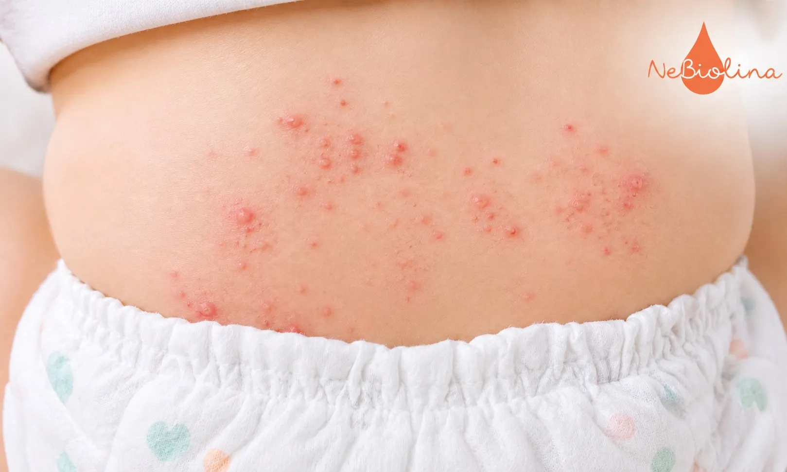 Phần lớn hăm tã nổi mụn không gây nguy hiểm nếu được chăm sóc kịp thời đúng cách
