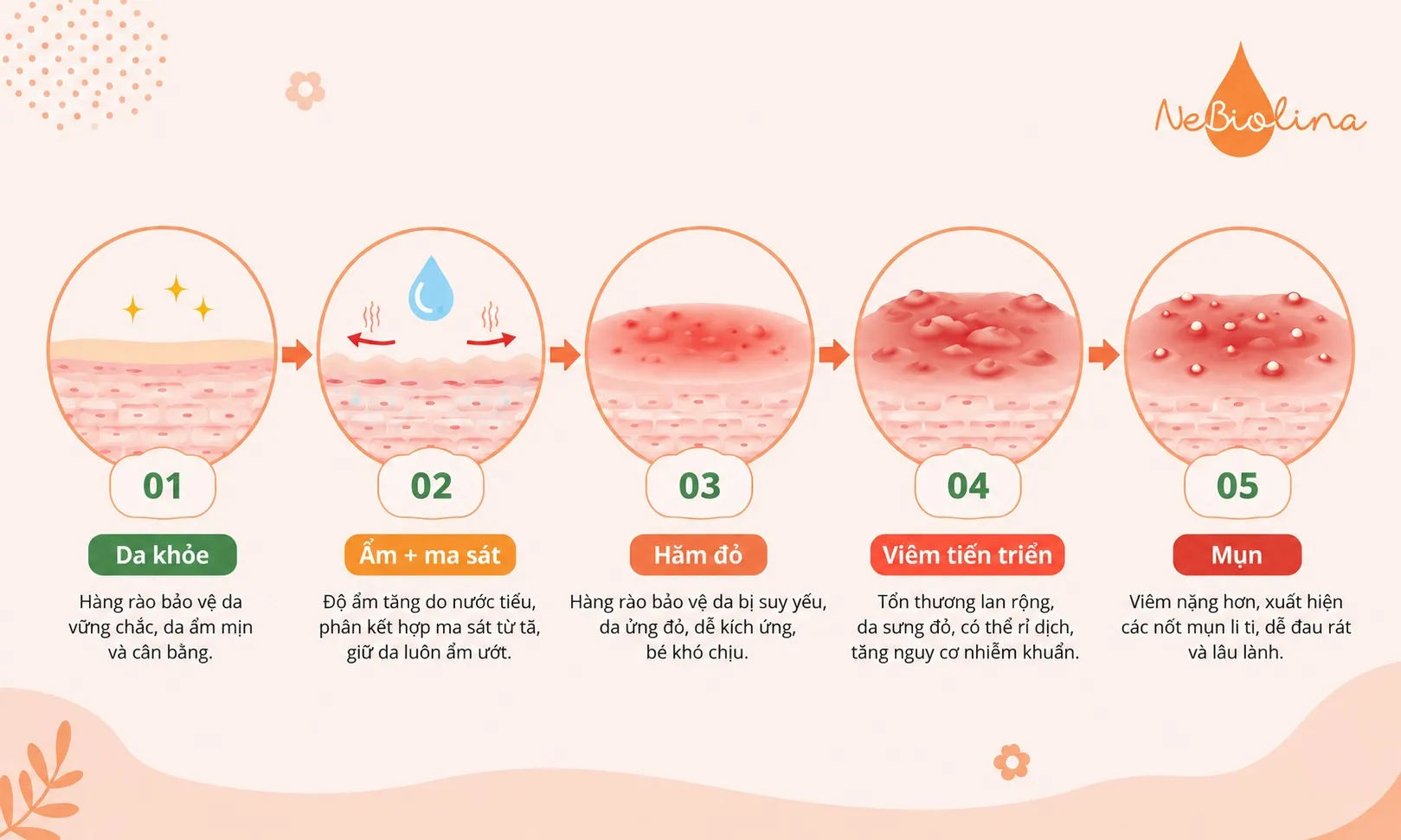 Hăm tã nổi mụn là một phản ứng viêm tiến triển.