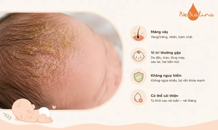 Cứt trâu là hiện tượng phổ biến ở trẻ sơ sinh