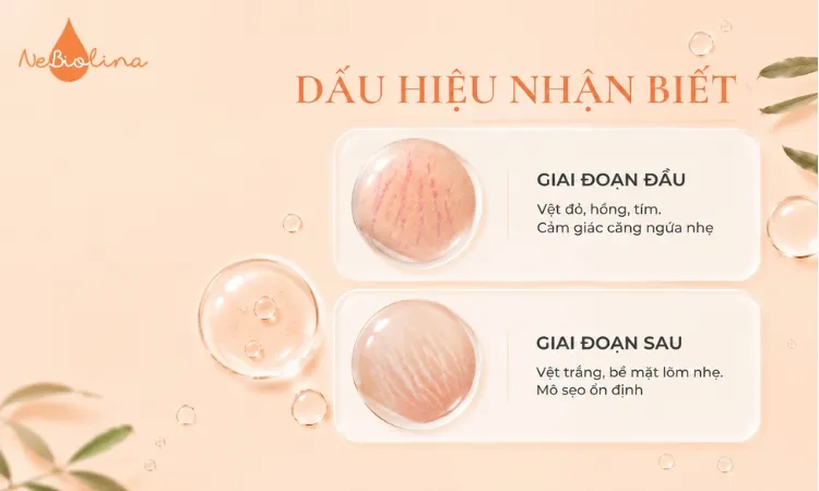 Rạn da trắng ở giai đoạn sau rất khó cải thiện