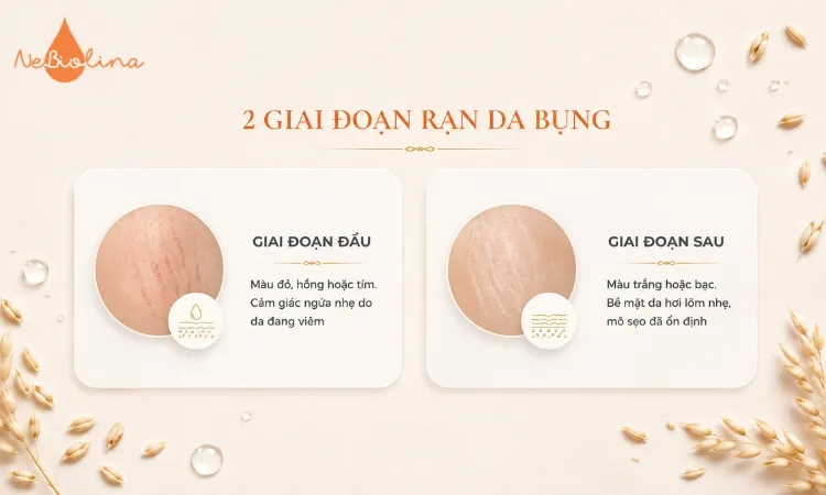 Dấu hiệu nhận biết rạn da bụng theo từng giai đoạn
