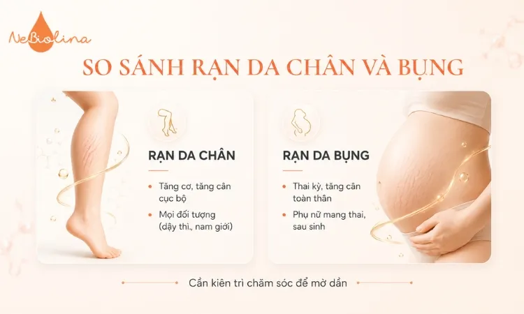Rạn da chân và rạn da bụng có thể xuất phát từ nhiều nguyên nhân khác nhau