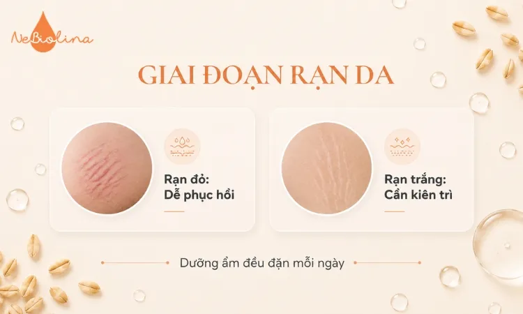 Chăm sóc da từ giai đoạn rạn đỏ sẽ có hiệu quả mờ rạn tốt hơn
