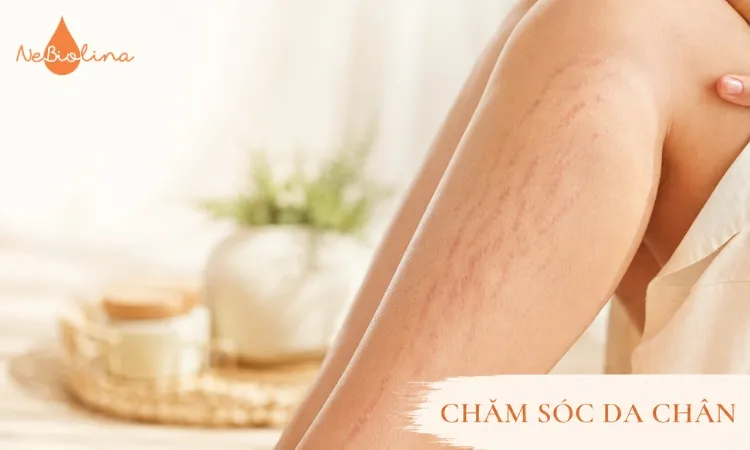 Rạn da chân là tình trạng phổ biến nhưng ít được chú ý