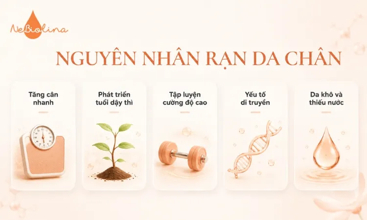 Rạn da chân có thể do các hoạt động thể chất