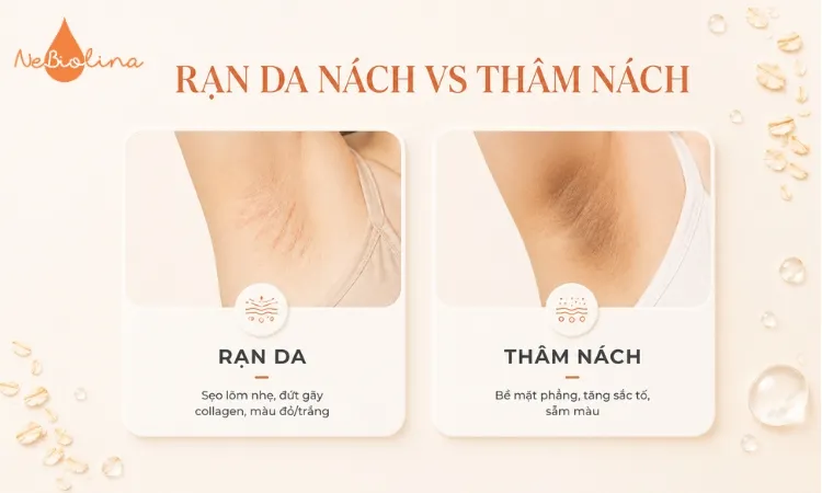 Rạn da nách và thâm nách là 2 tình trạng da khác nhau