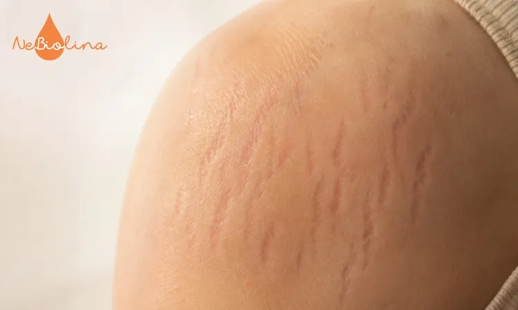 Vết rạn có màu đỏ ở giai đoạn mới hình thành